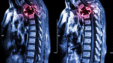 MRI of spinal tumor