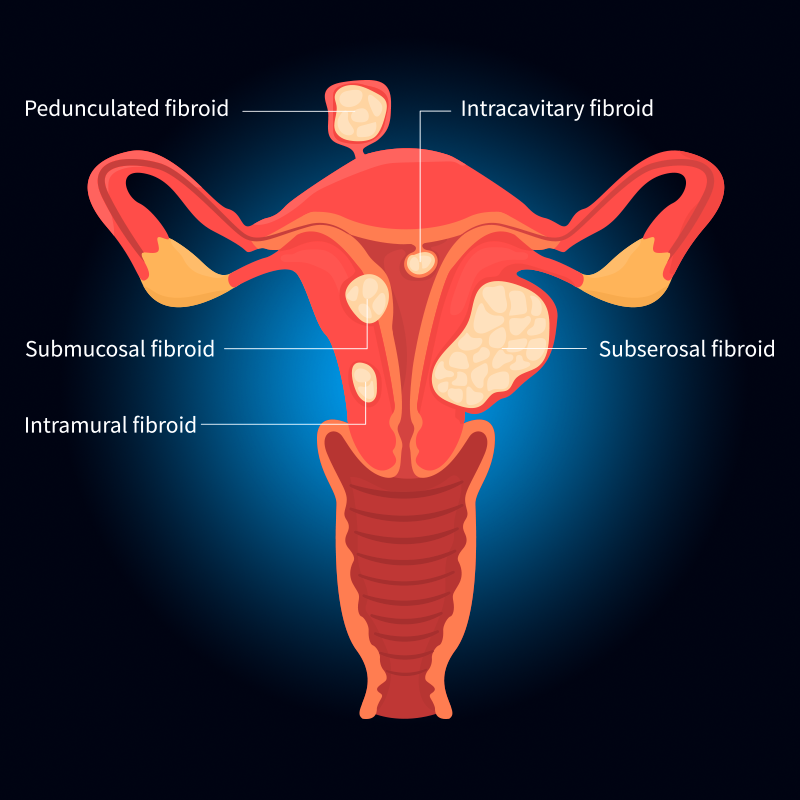 labled diagram of uterus showing uterine fibroid location