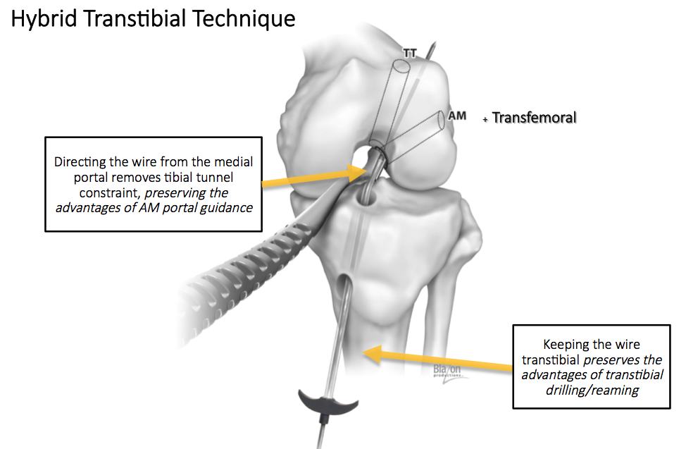 vector image of the hybrid transtibial technique
