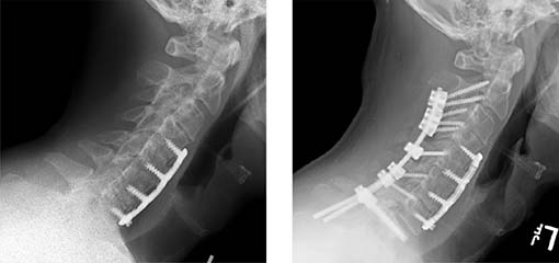 Cervical spine surgery (before and after)