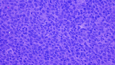 image of Diffuse large B-cell lymphoma