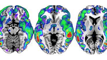Neuroimaging brain scans during menopause