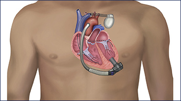vector illustration of lvad in the heart of a male patient