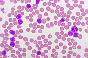Group of leukemia cells