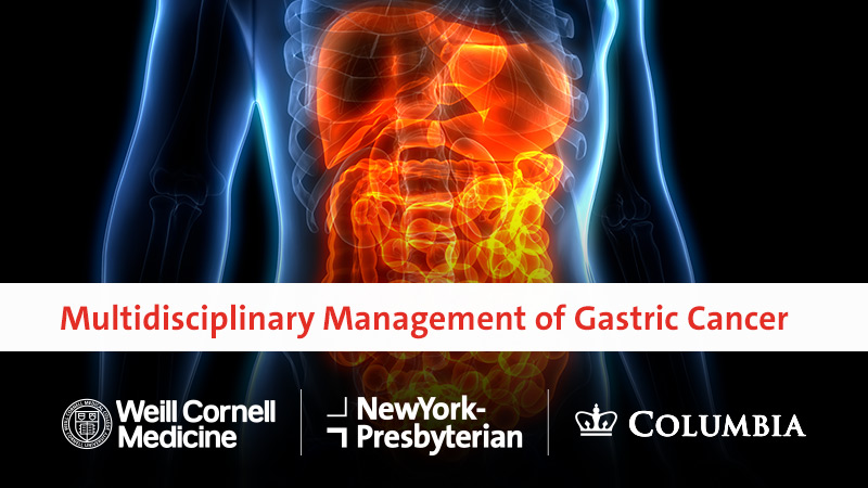 Multidisciplinary Management of Gastric Cancer