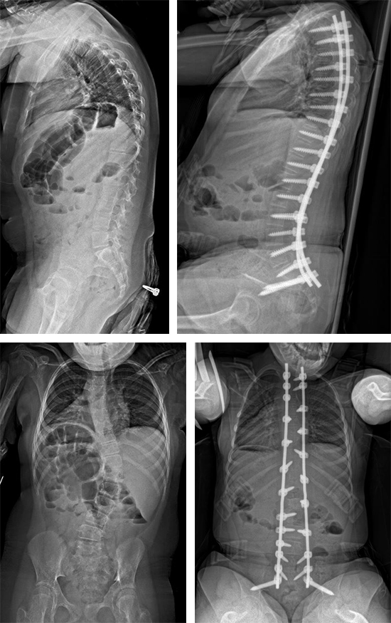 images of spinal deformity x-rays