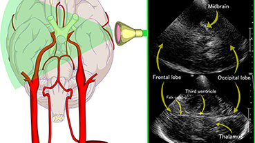 illustration showing the transcranial Doppler sonography on the left temporal window. The imaging shows the organs in the brain on both right and left hemispheres