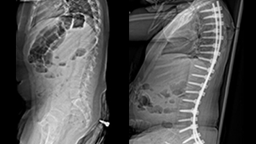 images of spinal deformity x-rays
