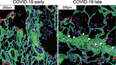 image of lung cells damaged by COVID-19 undergoing analysis