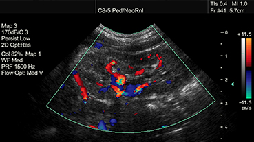Doppler ultrasound of a pediatric kidney