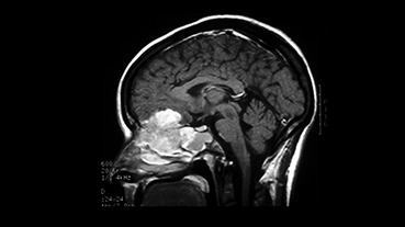 Image of MRI of esthesioneuroblastoma, a rare type of cancer that forms in the tissues of the upper part of the nasal cavity