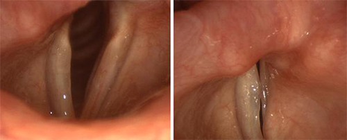 Two photos of patient's vocal folds