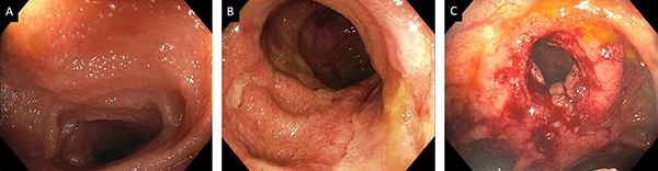 Assessment of disease activity of Crohn’s disease after ileocolonic resection and anastomosis.