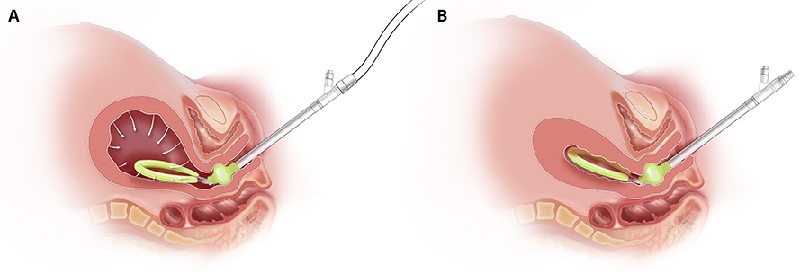 two vector illustrations of vacuum being used inside uterus