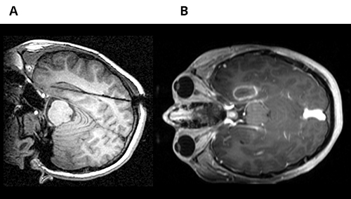MRI results of brain scan
