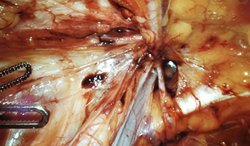 image of hernia repair surgery