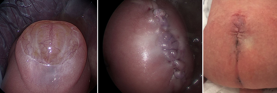 Fetal myelomeningocele defect, closure following fetoscopic procedure