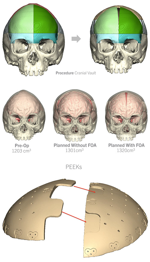 Diagram showing Cranial Vault Remodeling