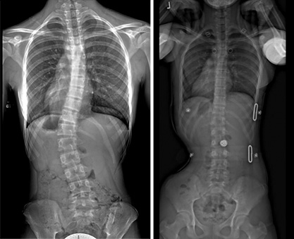 images of brace correction