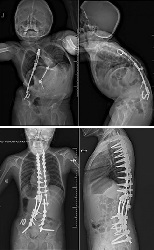 images of brace correction