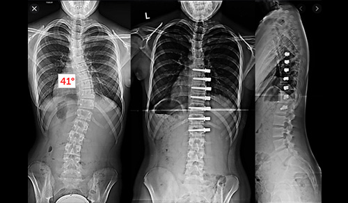 X-ray of Anterior Vertebral Body Tethering