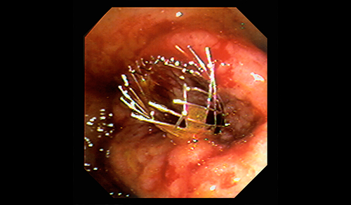 Endoscope view of a wire mesh stent in the colon of a patient with colon cancer