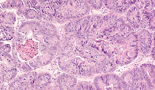 Photomicrograph of adenocarcinoma of endometrium in a biopsy
