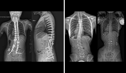 images of Pre and post complex spine surgery, and pre and post bracing