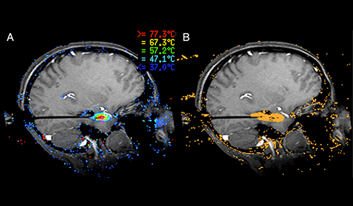 brain scans of laser ablation for mesial temporal lobe epilepsy