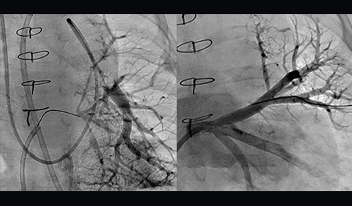Before and after treatment angiograms showing left pulmonary vein network