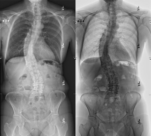 osh-spine-scoliosis-and-spinal Deformity.jpg