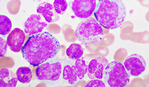 Chronic myeloid leukemia (CML) cells under microscope