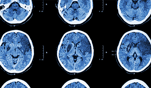 Ischemic stroke - CT of brain showing cerebral infraction