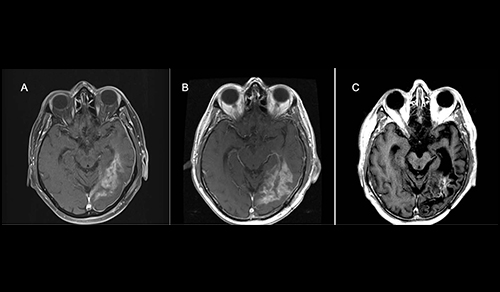 Magnetic resonance contrast-enhanced axial T1 images