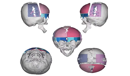 image of 3D planning models for craniofacial surgery