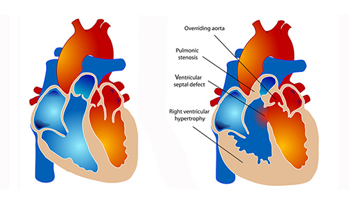 vector digital illustration of normal heart (left) and with tetralogy of Fallot (right)