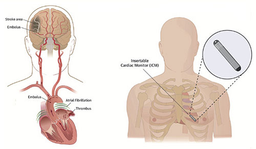 Illustration of implantable Cardiac monitor to detect atrial fibrillation after stroke.