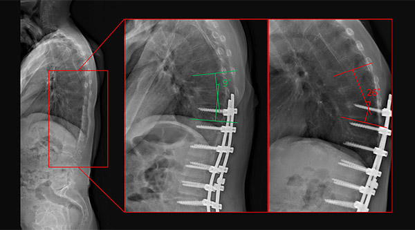 radiology images of a patient with PJK