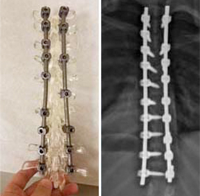 image of Fusion hardwares with post-op xrays