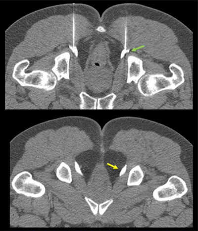 image of CT guided, bilateral pudendal nerve blocks