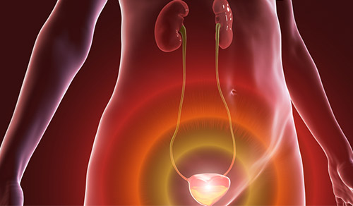 3D illustration of overactive urinary bladder in a female