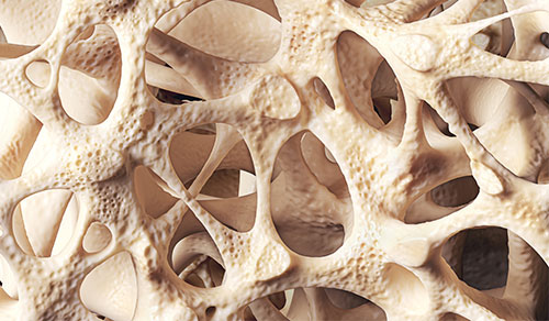 3D Illustration of bone structure affected by osteoporosis