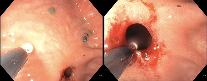 Picture from endoscopic surgery