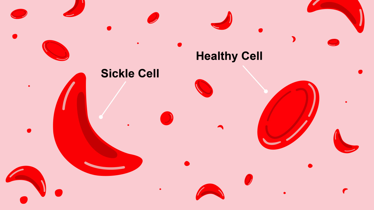 Sickle Cell versus Healthy Cell