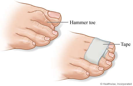 Hammer Toe: Diagnosis & Treatment