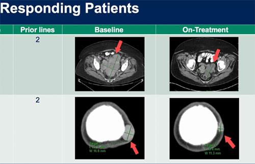 responding patients MRI images in a chart