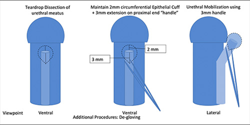 image of Tear Drop Urethral Mobilization and Advancement Repair