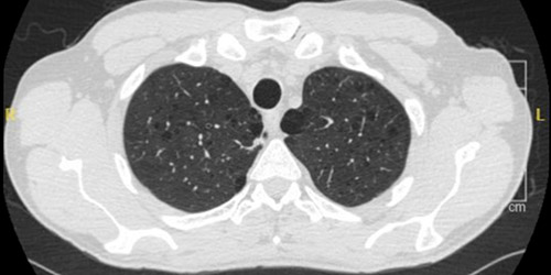 CT scan of emphysema in a person living with HIV