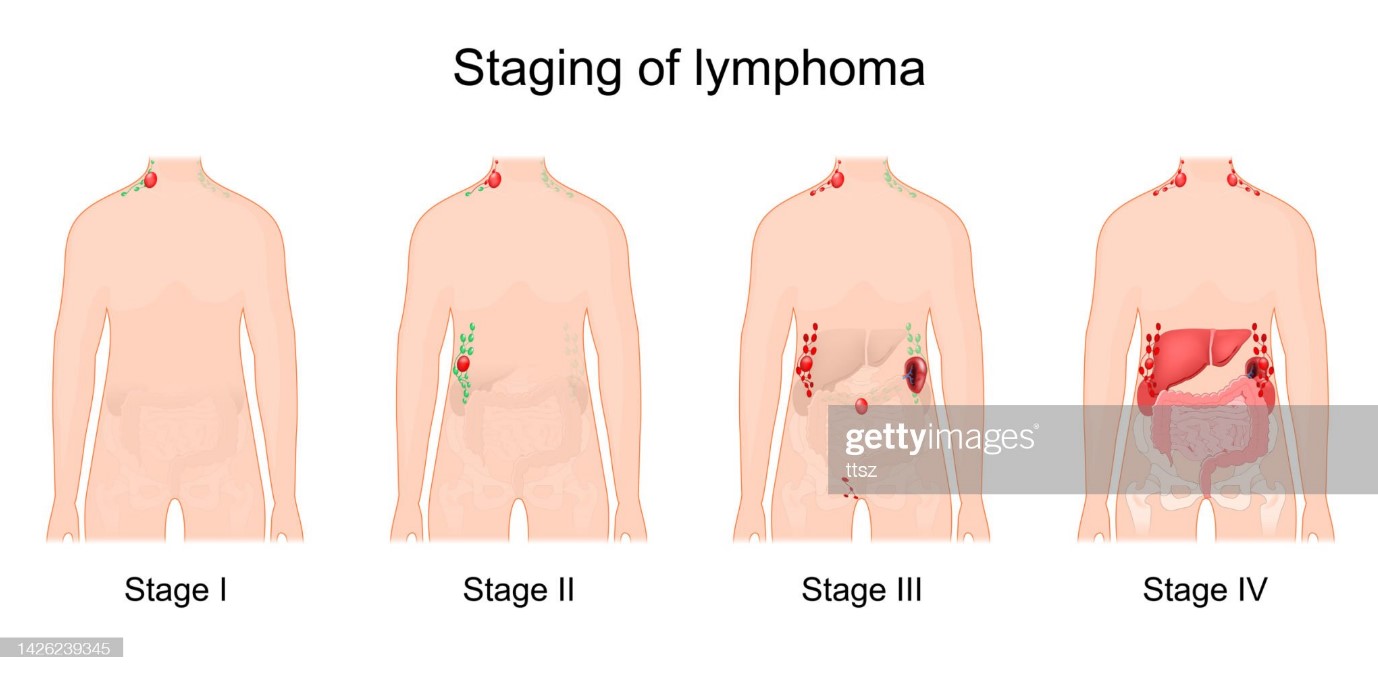 Hodgkins Lymphoma Symptoms And Causes Newyork Presbyterian