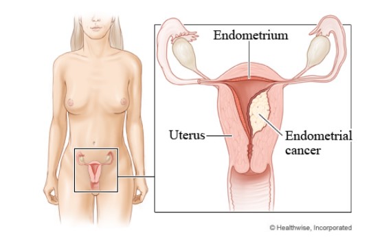 Anatomical diagram of abnormal growth of cells in the endometrium indicating endometrial cancer in a female body.